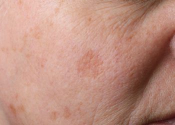 Rigenerare pelle dopo il mare, perchè e come