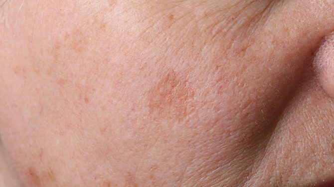 Rigenerare pelle dopo il mare, perchè e come