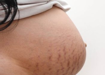 Smagliature rosse: aiuto!