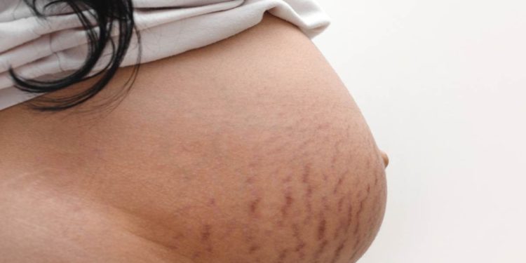 Smagliature rosse: aiuto!