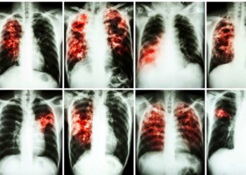 Mese Fibrosi Polmonare: in Piemonte un team gratuito di esperti