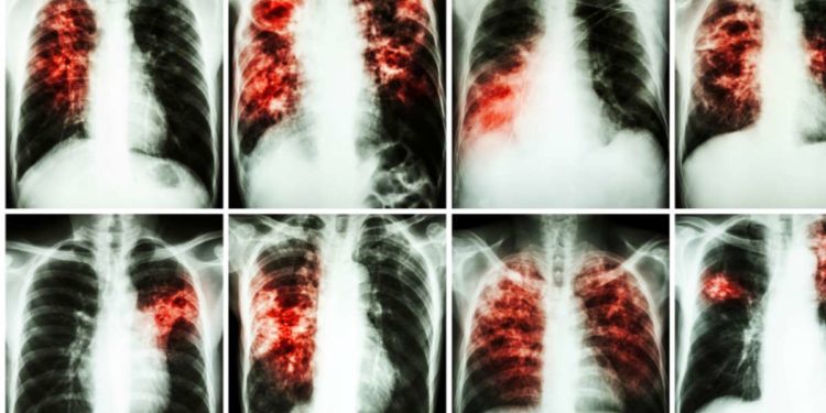 Mese Fibrosi Polmonare: in Piemonte un team gratuito di esperti