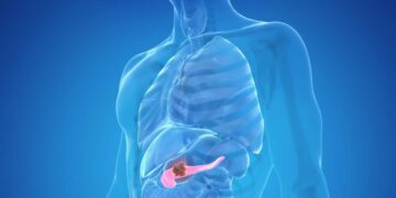 Un farmaco anti-asmatico con potenziali effetti per il trattamento del tumore al pancreas