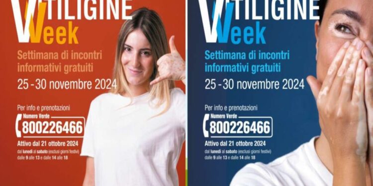 La ‘Vitiligine Week’ arriva in Liguria: incontri gratuiti con i dermatologi