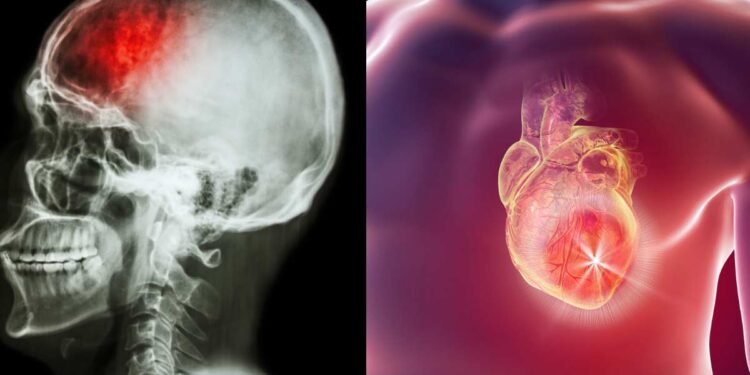 Ictus e infarto nella donna, a Milano focus su sintomi e strategie
