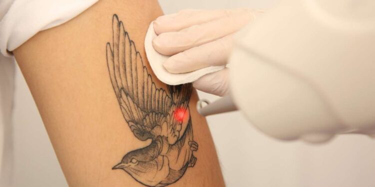 Laser e rimozione dei tatuaggi: tra innovazione e sicurezza
