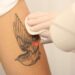 Laser e rimozione dei tatuaggi: tra innovazione e sicurezza