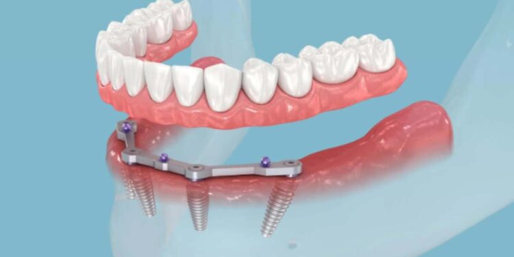Dal sorriso ritrovato al viaggio intelligente: perché sempre più italiani scelgono l’Albania per cure dentali