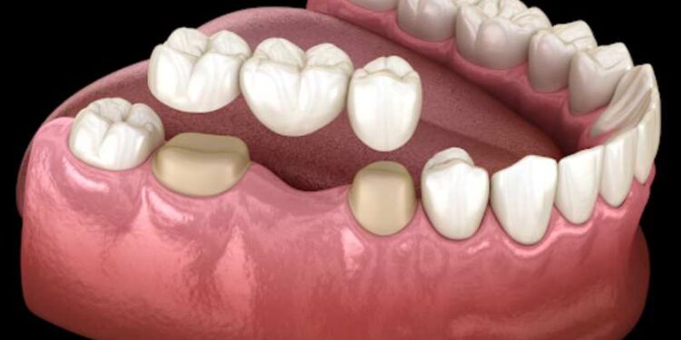 Corone dentali: guida pratica a materiali, durata e costi (con consigli per chi valuta l’Albania)
