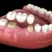 Corone dentali: guida pratica a materiali, durata e costi (con consigli per chi valuta l’Albania)